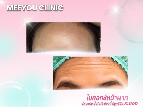 ปรับรูปหน้า ยกกระชับ เติมเต็มความอ่อนเยาว์ บริการ HIFU, โบท็อกซ์ และฟิลเลอร์ (2)